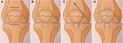 A minimally invasive bipolar surgical approach for the treatment of patellar fracture using the tension-band wiring technique